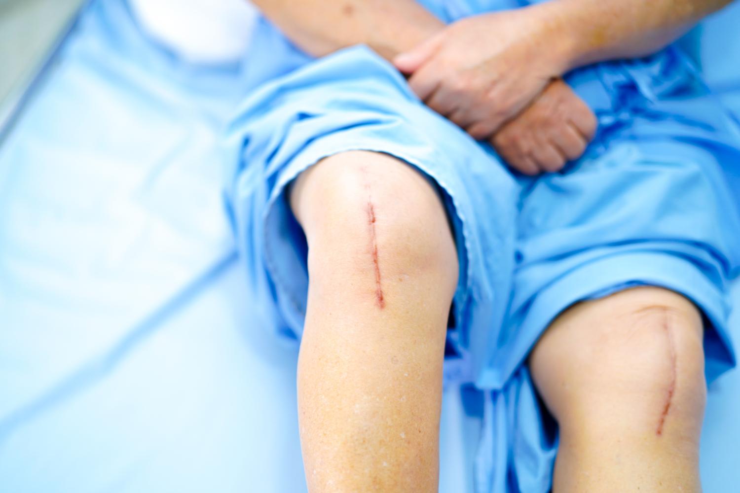 Patient after knee replacement surgery