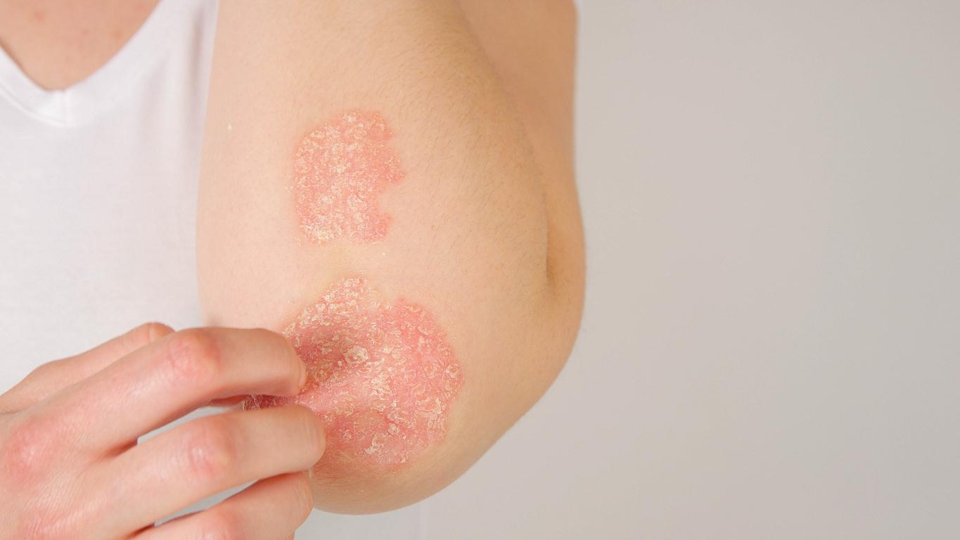 psoriasis 