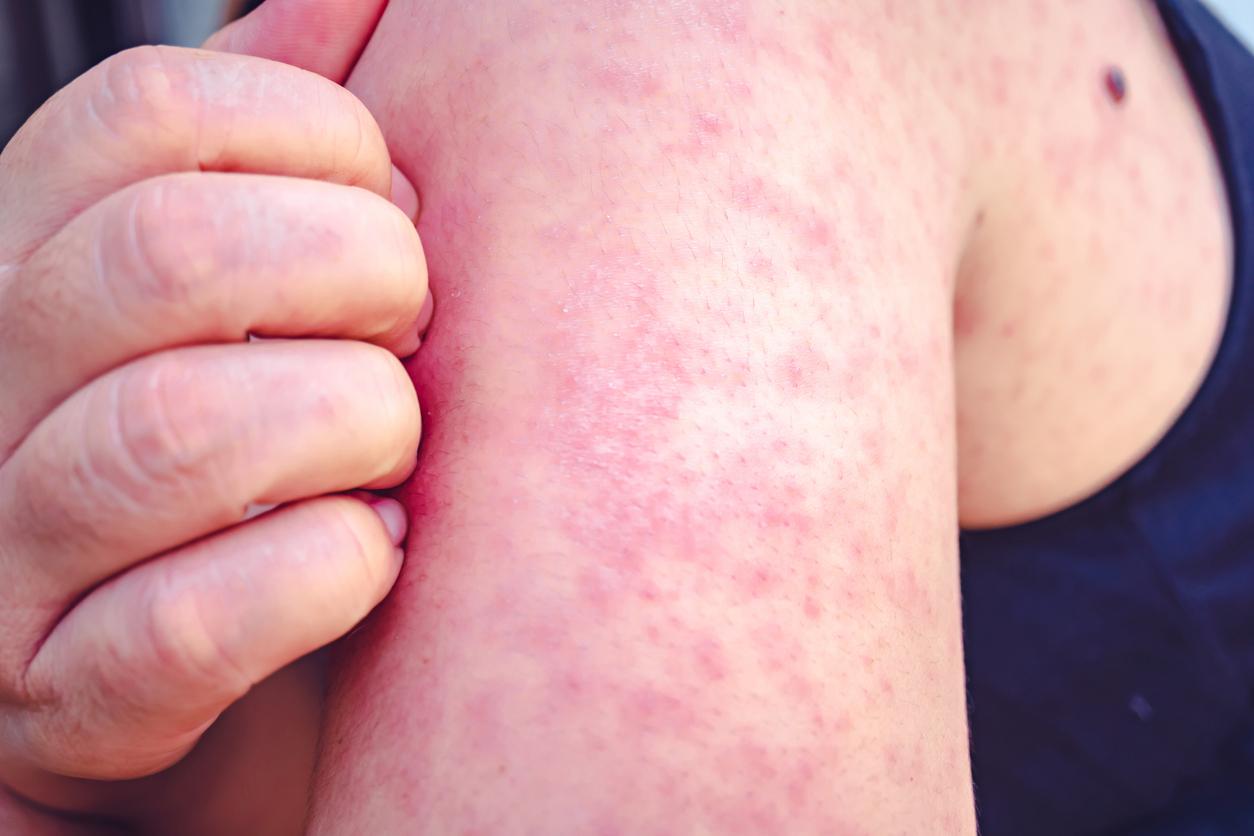 measles arm