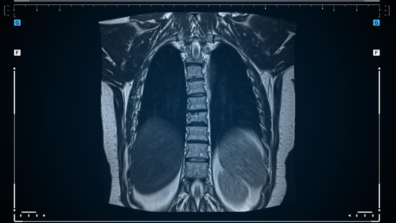 lung MRI