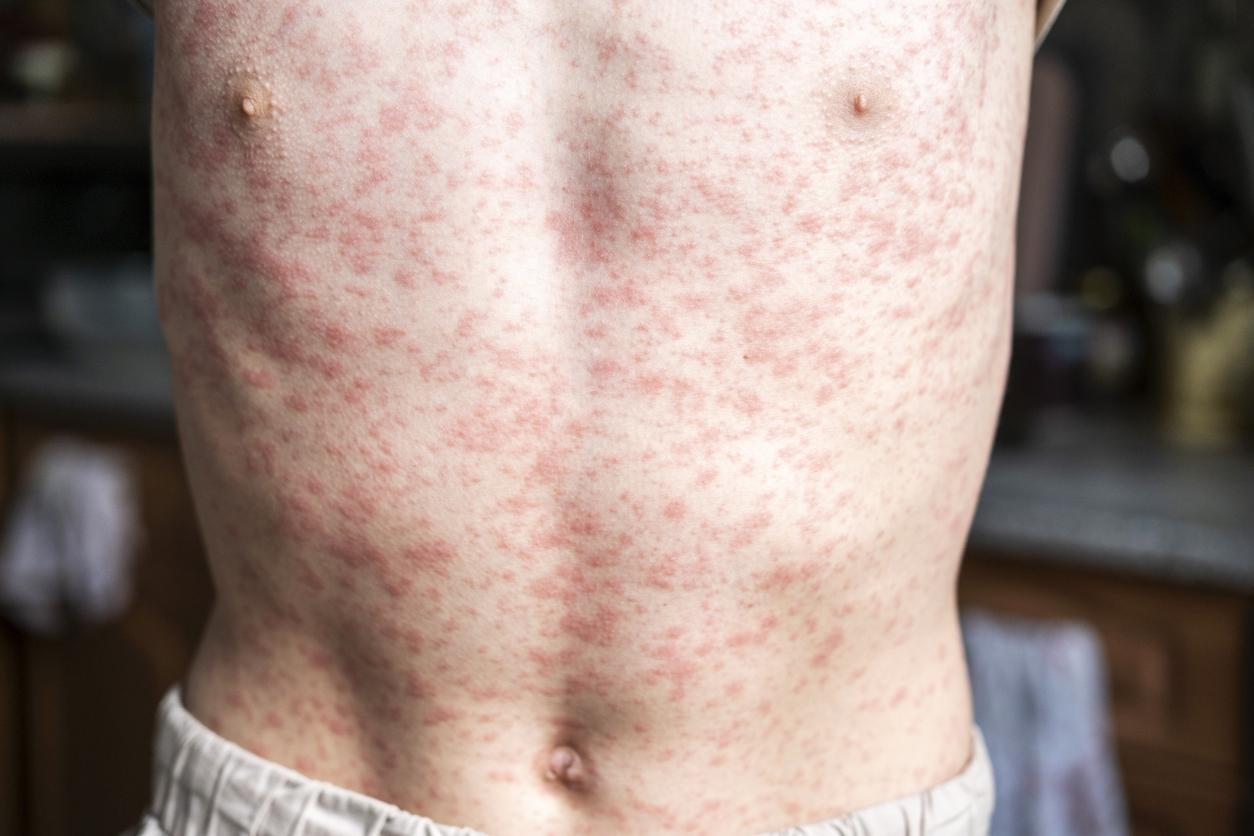 measles torso