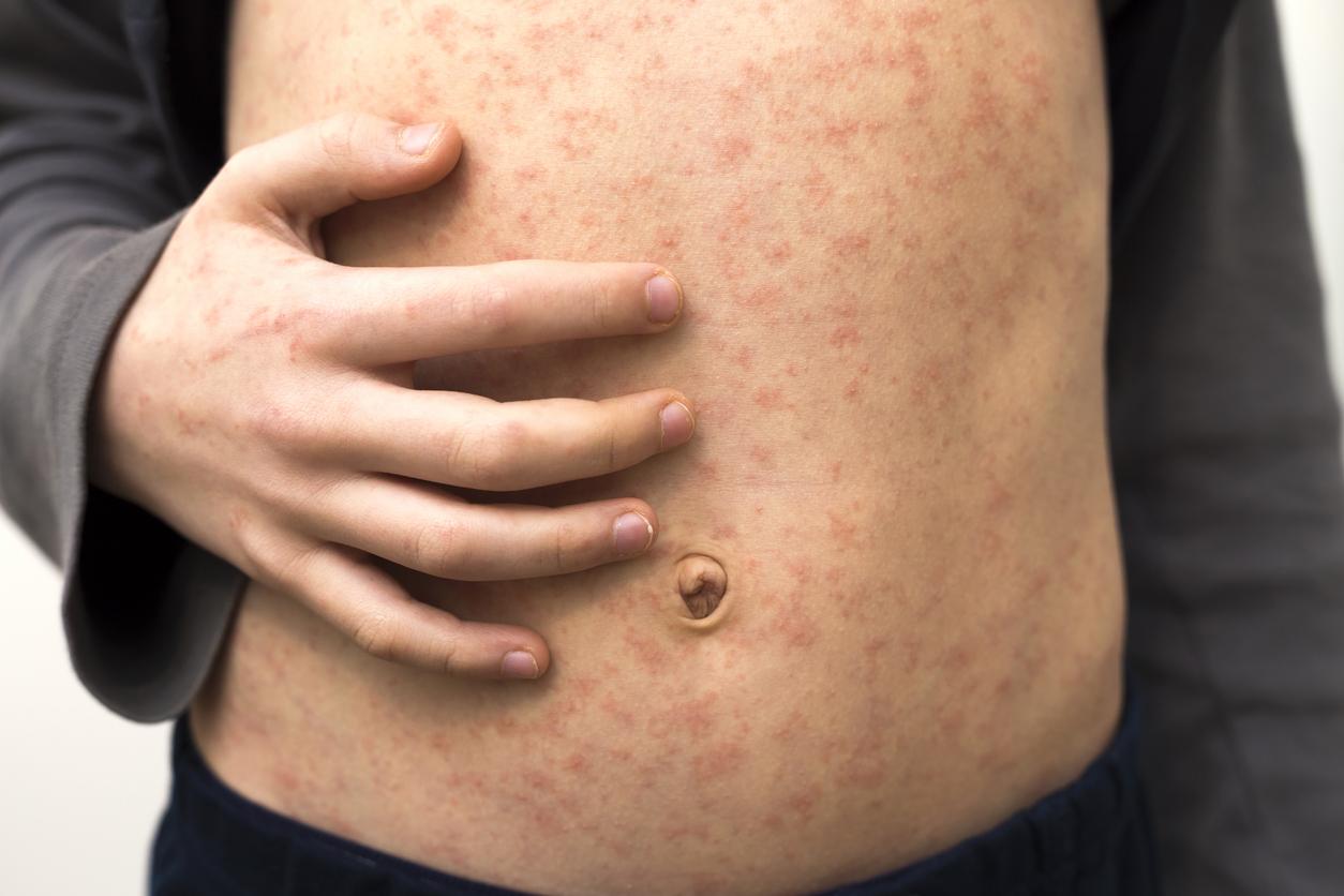 measles abdomen