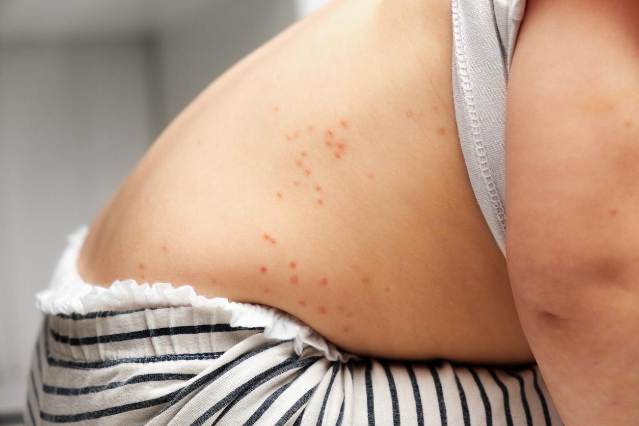measles child back