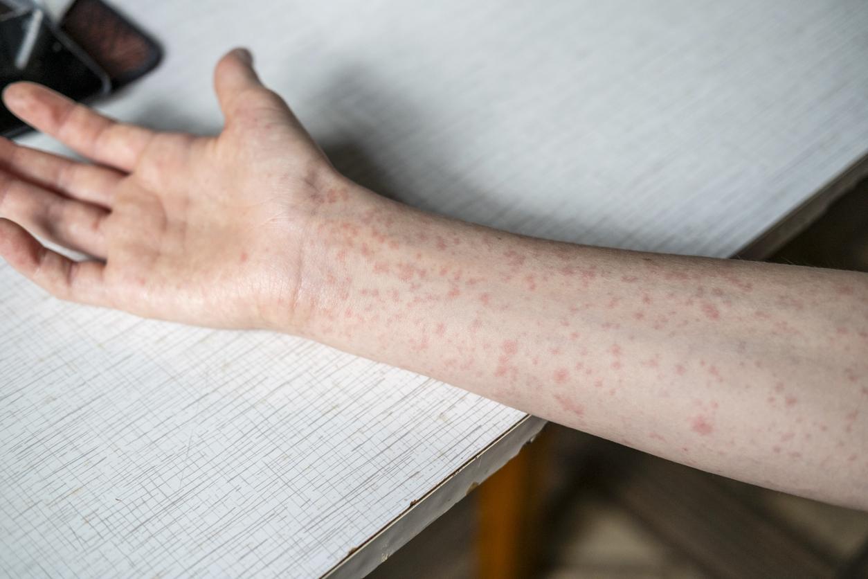 measles rash on arm