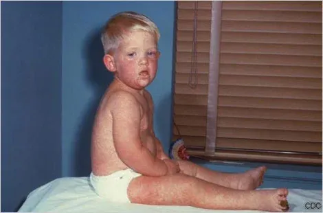measles child 