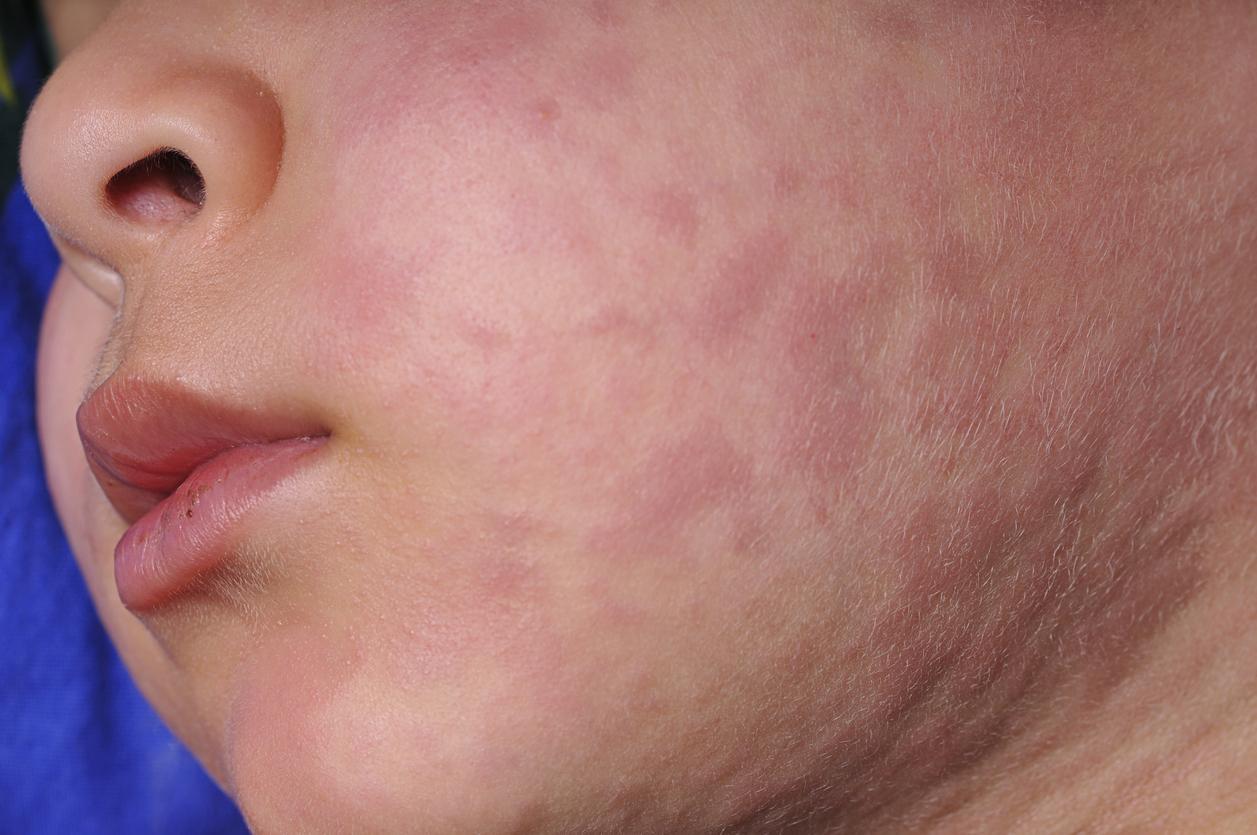 child with measles