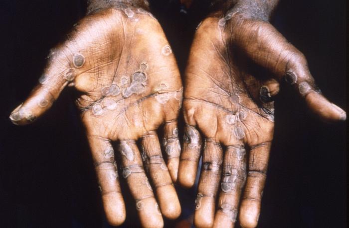 mpox lesions on hands