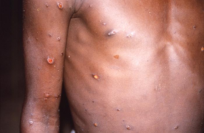 mpox lesions