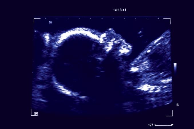 Ultrasound