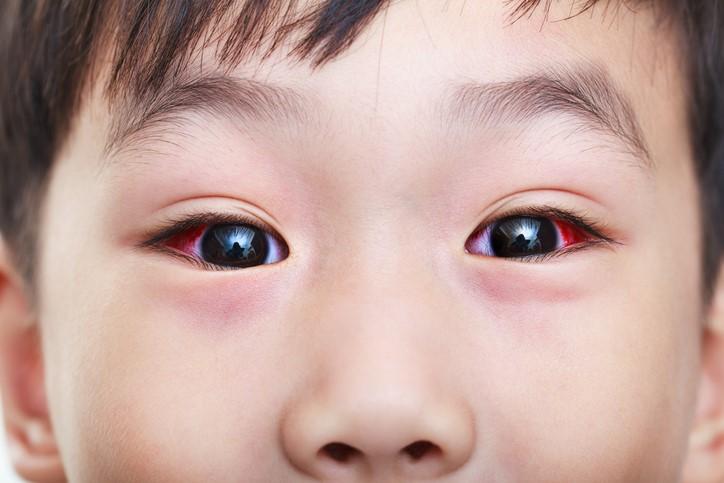 Close-up of boy with conjunctivitis