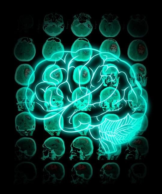Brain superimposed on CT scans