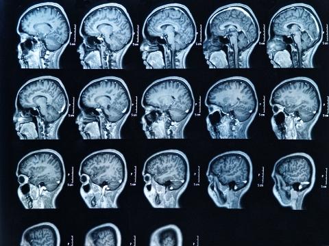 Brain scan