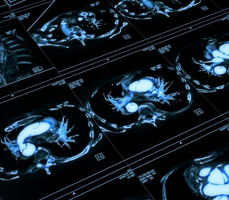Chest CT scan