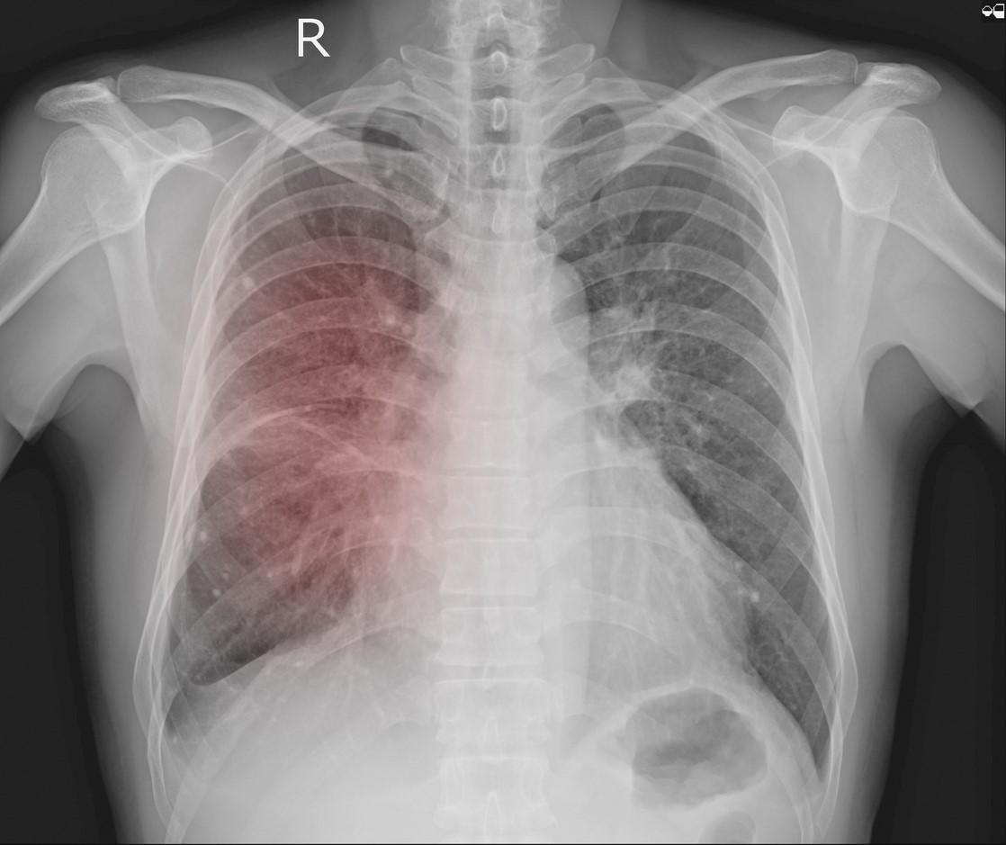 Chest x-ray