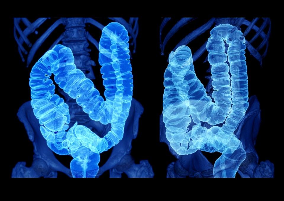 Colon imaging