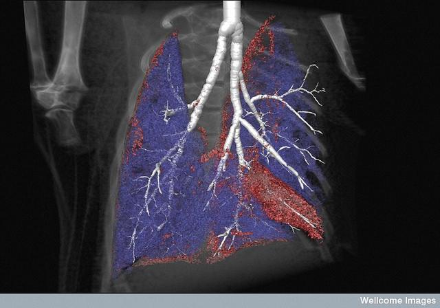 cystic fibrosis