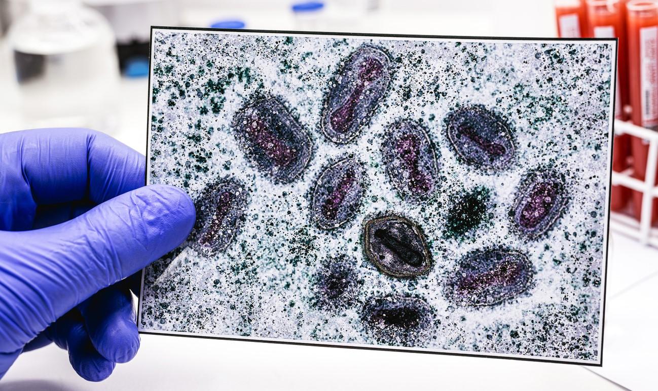 Gloved hand holding photo of monkeypox viruses