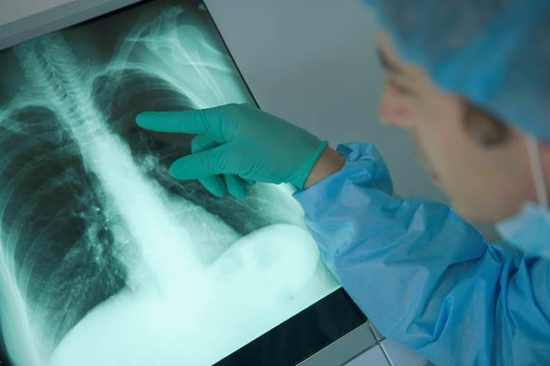 Clinician examining lung film