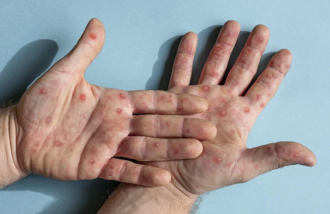 monkeypox hands