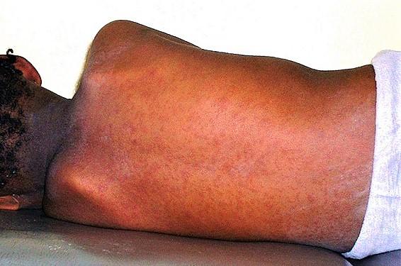 Measles in child