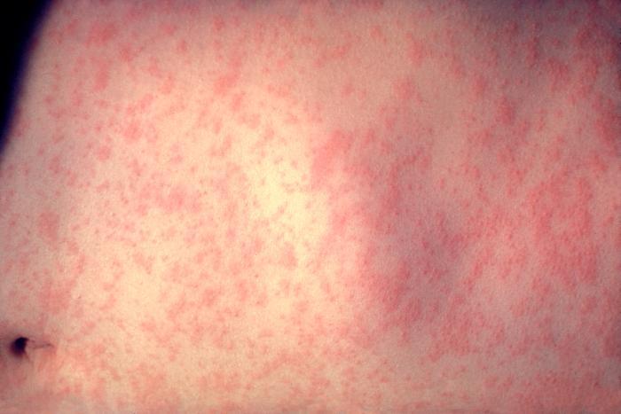Skin rash in measles patient