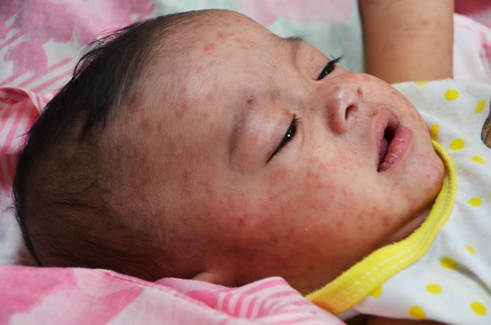 Baby with measles