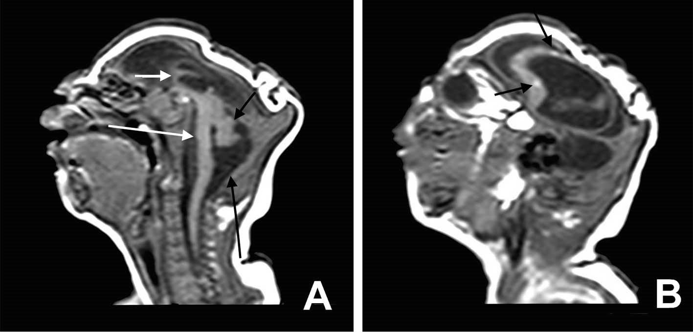 Microcephaly MRI