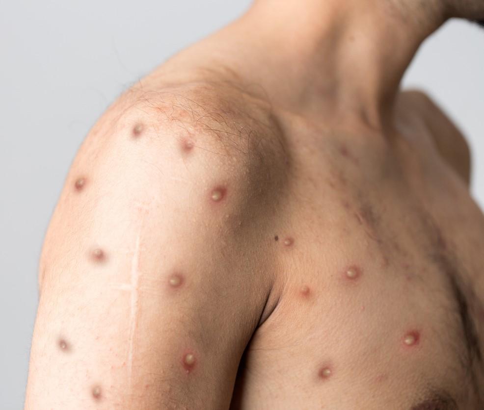 Monkeypox lesions on chest and arm
