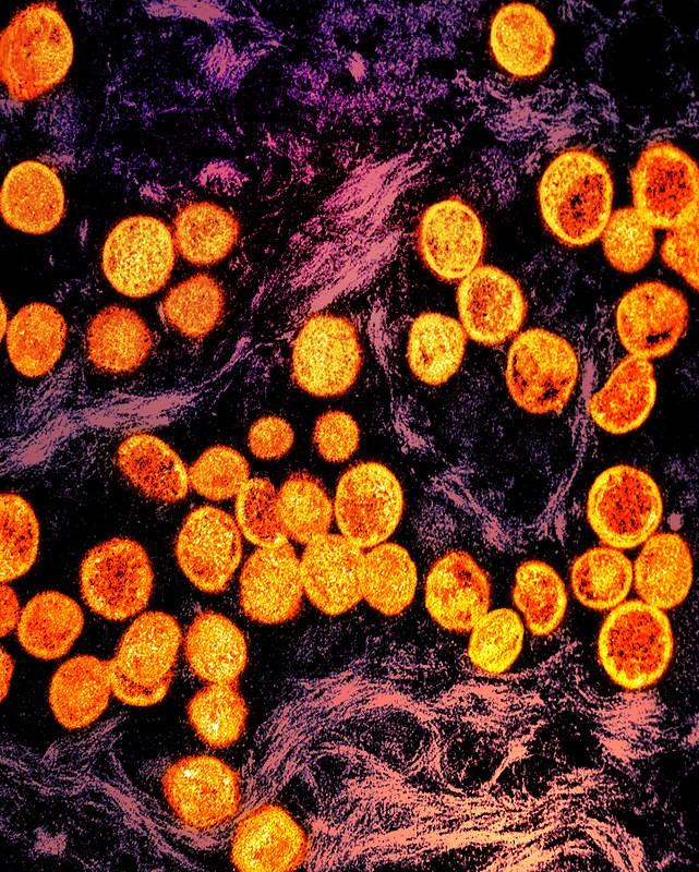 Who Is Most Vulnerable To The Monkeypox Virus?