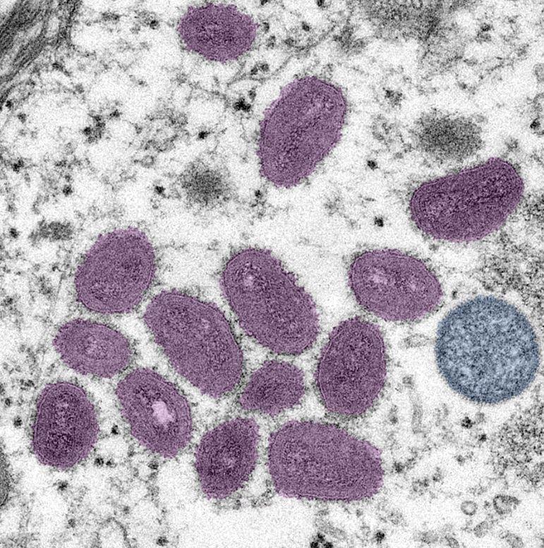 WHO 14,000 monkeypox cases worldwide, 5 deaths CIDRAP photo pic picture