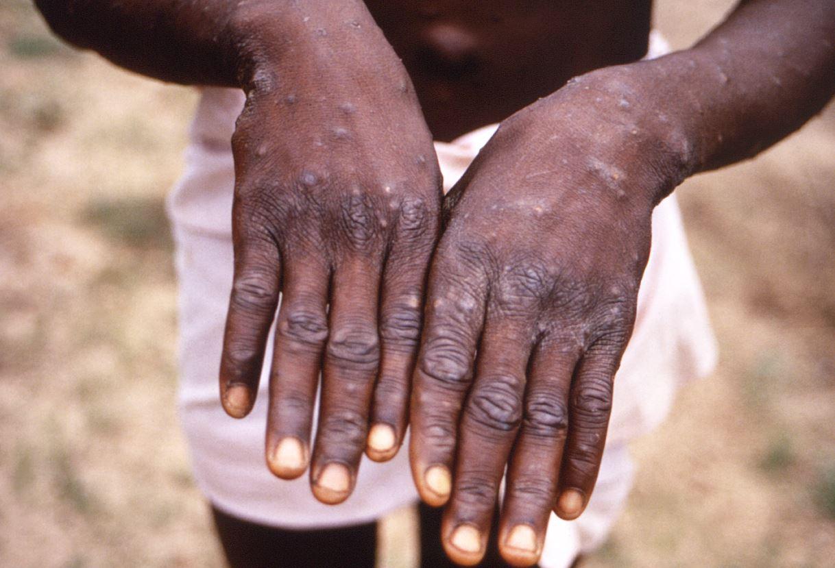 Monkeypox on back of hands