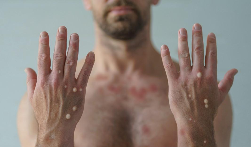 Monkeypox blisters on man's hands and chest