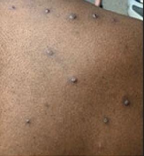 Monkeypox lesions on back and shoulder