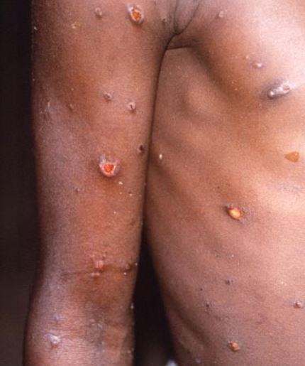Monkeypox lesions on arm and torso
