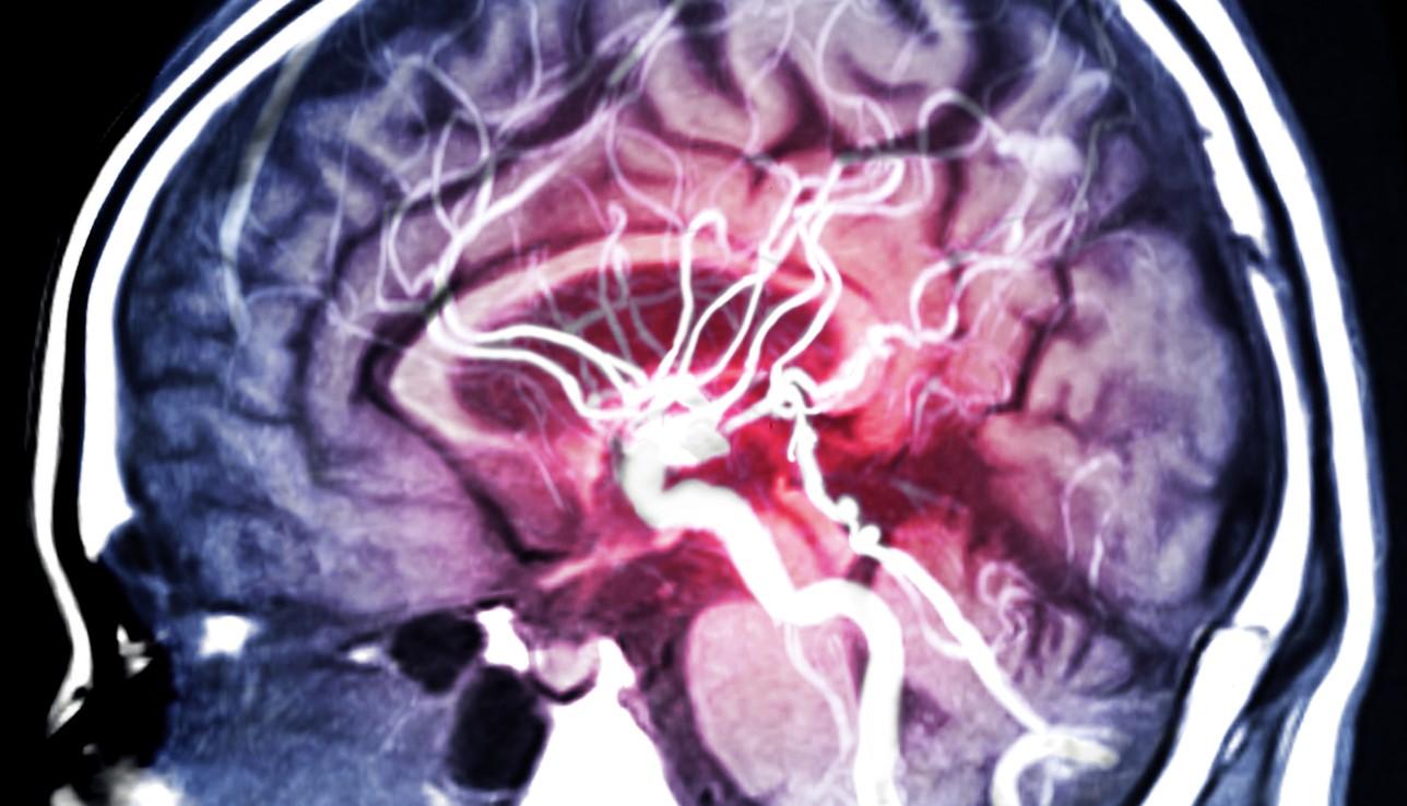 MRI of brain blood vessels