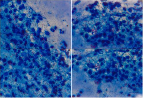 Tuberculosis bacteria