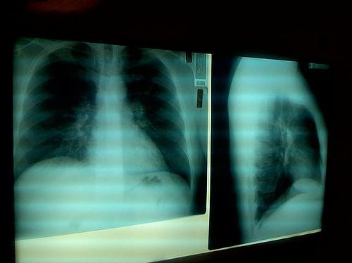 Pneumonia chest x-ray
