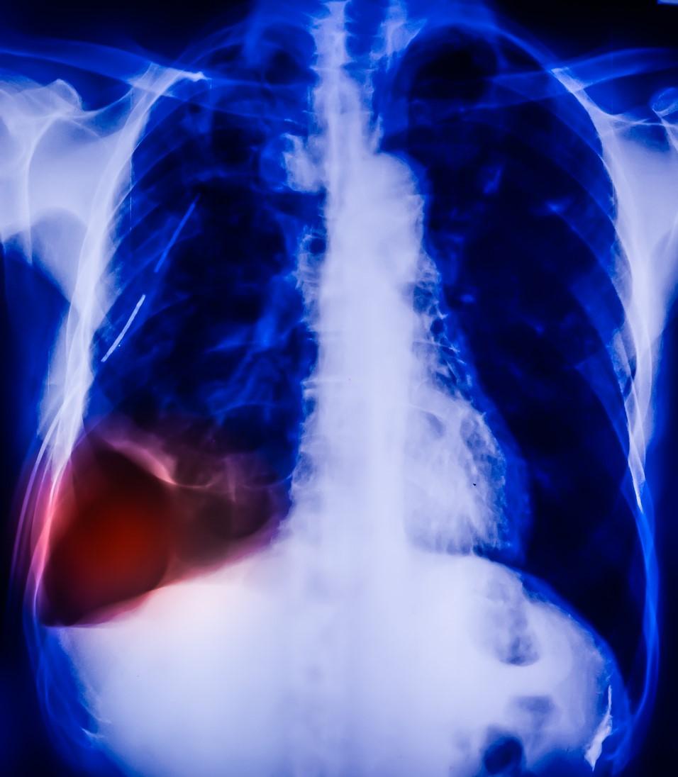 Pneumothorax x-ray