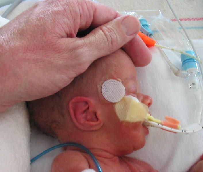 Premature baby