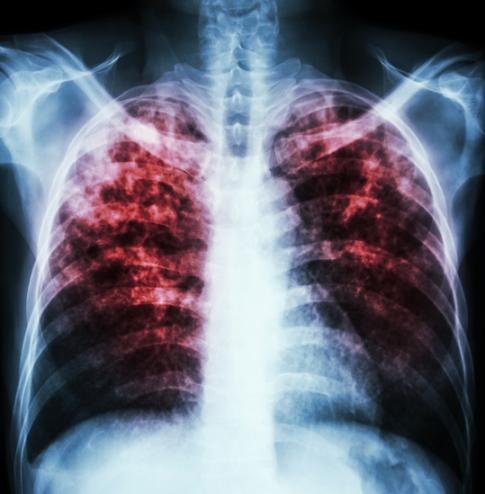 Pulmonary tuberculosis x-ray