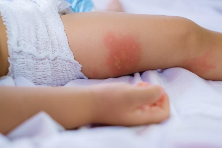 Rash on baby's leg