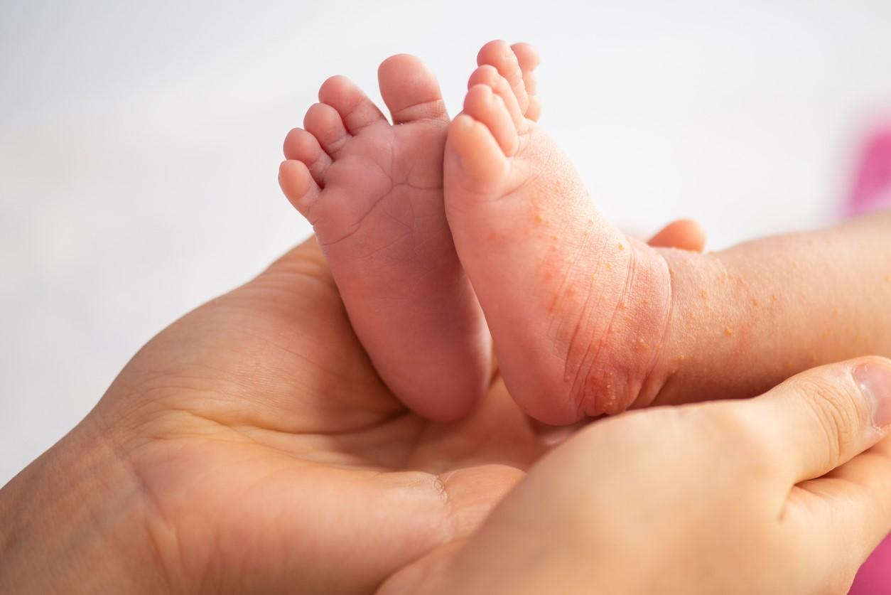 Rash on feet and ankles of baby