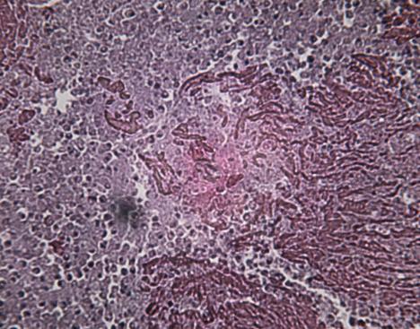 TB-infected lung tissue