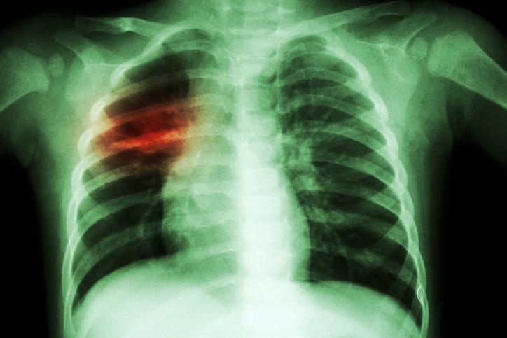 Tuberculosis chest x-ray