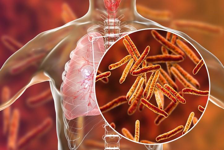 Tuberculosis in lungs