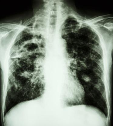 TB chest x-ray