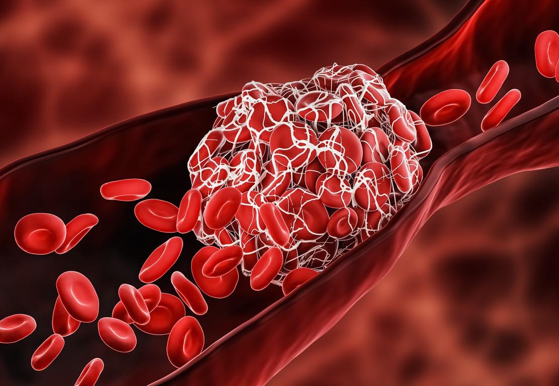 Blood clot blocking blood vessel