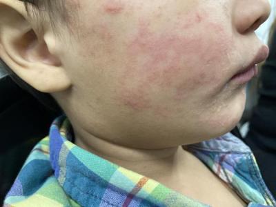 boy with measles 