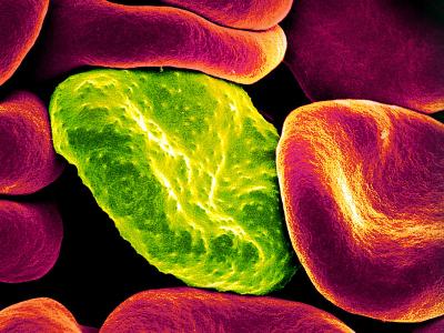 malaria infected rbc