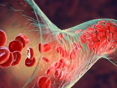Blood clot and platelets